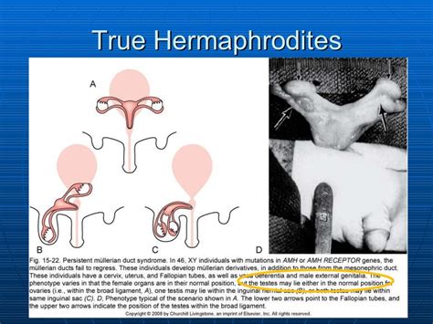 can an intersex person get themselves pregnant|Pregnancy in true hermaphrodites and all male offspring to date